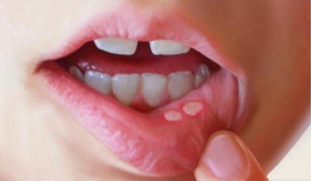 mouth-ulcers-inmarahi