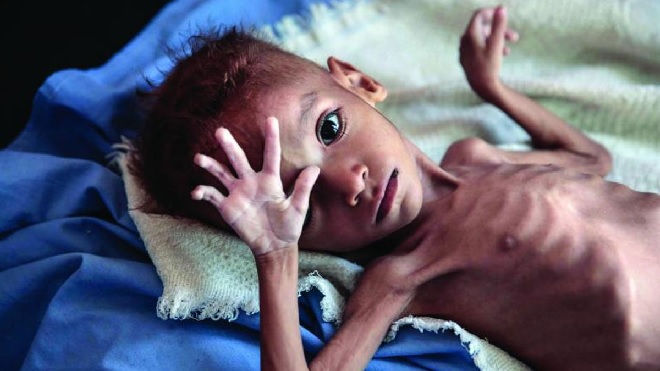 malnourished-child-inmarathi