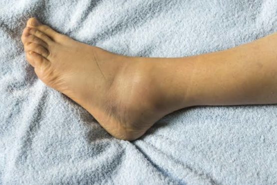 feet swelling inmarathi
