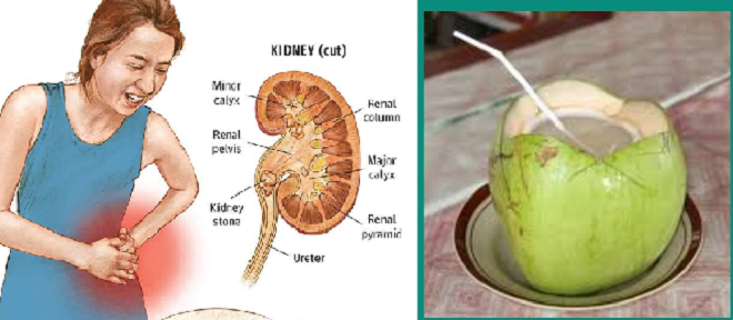 kidney stone inmarathi